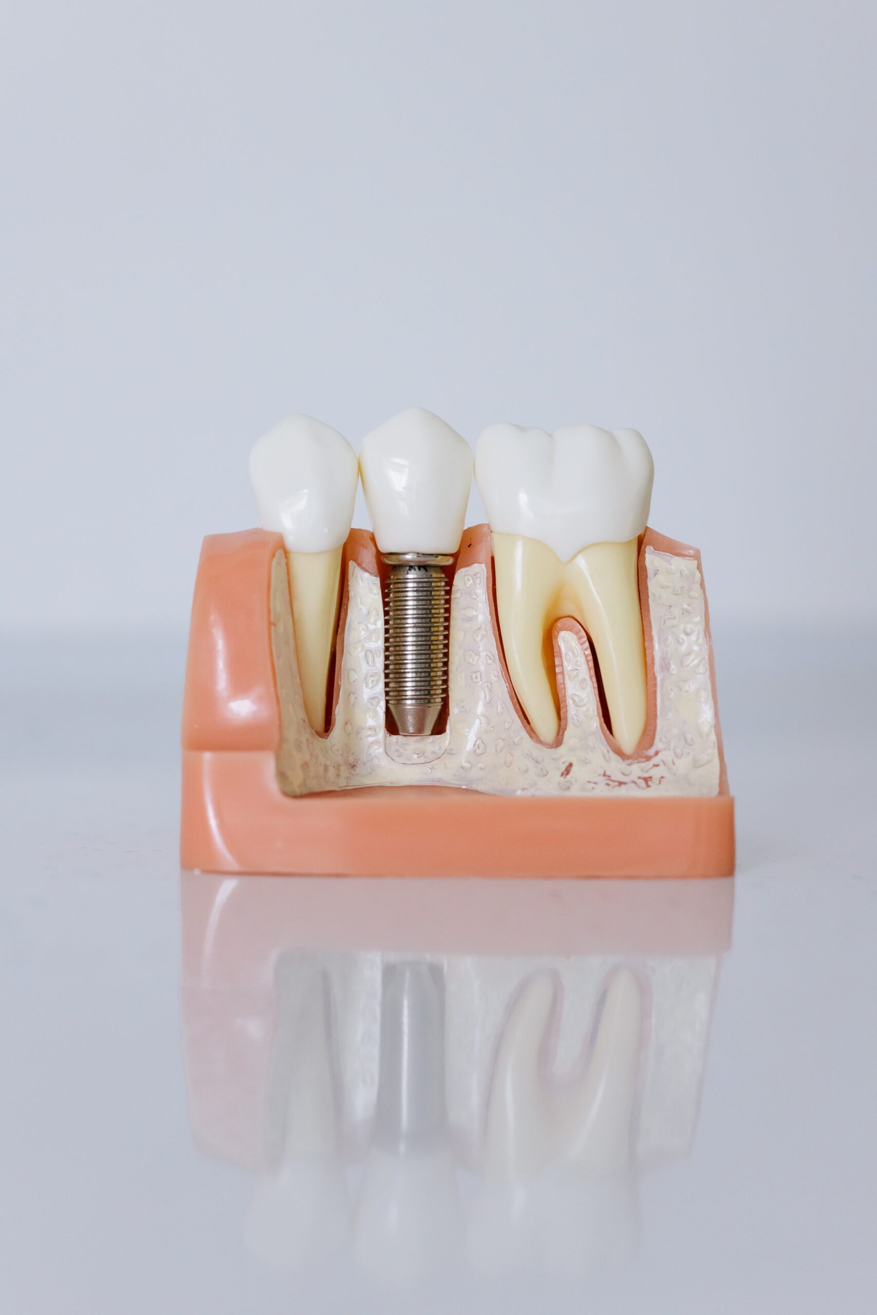 The Complete Guide to Choosing Dentures: Everything to Know