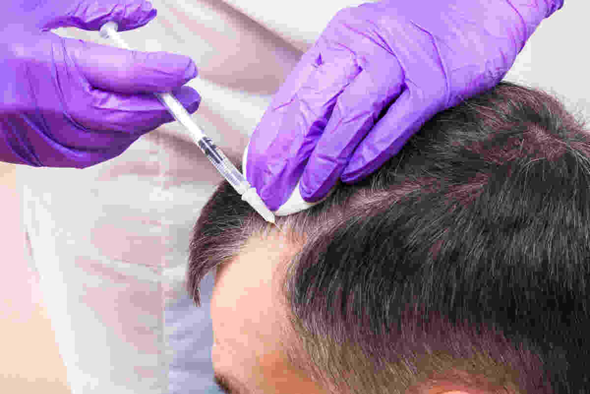 Everything You Need To Know When Choosing Hair Restoration Clinics
